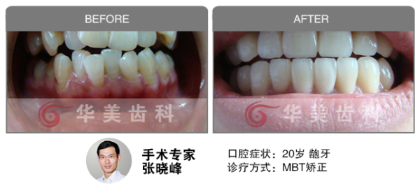 MBT正畸矫正龅牙前后对比图片