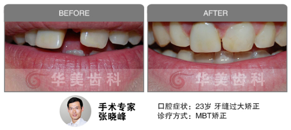 MBT正畸矫正牙缝过大前后对比图片
