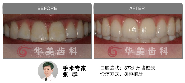 美国3I种植牙修复牙齿缺失前后对比图片