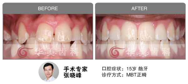 MBT正畸矫正龅牙前后对比图片