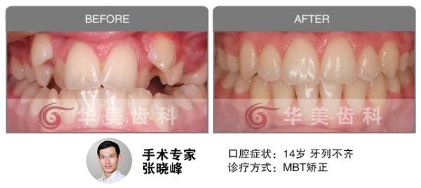 MBT正畸矫正牙列不齐前后对比图片