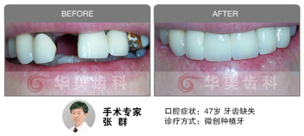 微创种植牙修复牙齿缺失前后对比图片