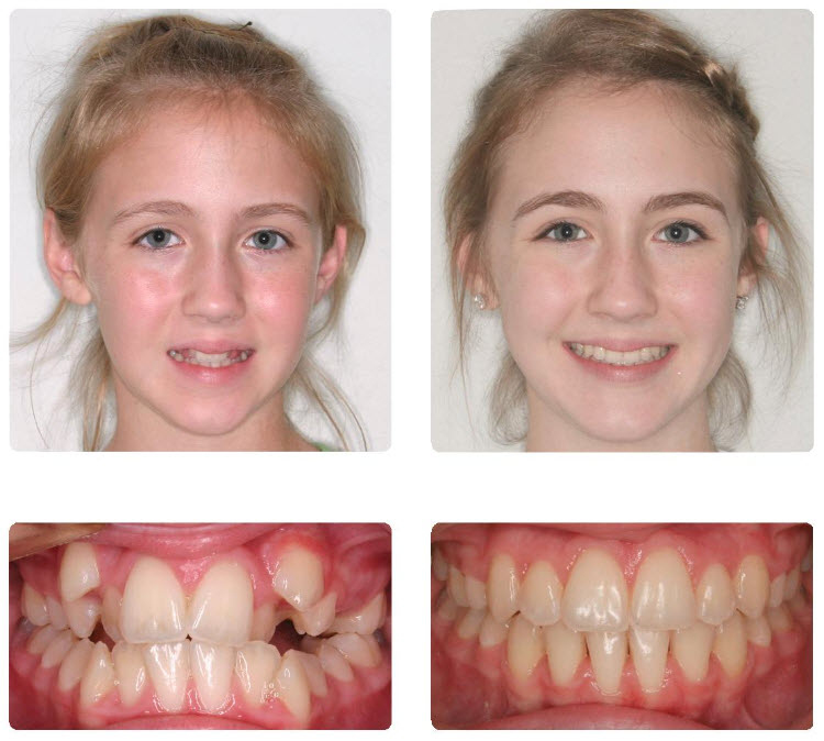 儿童牙齿正畸c.o.双重系统案例对比图