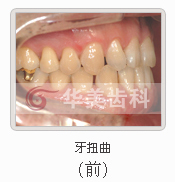 牙扭曲案例图片