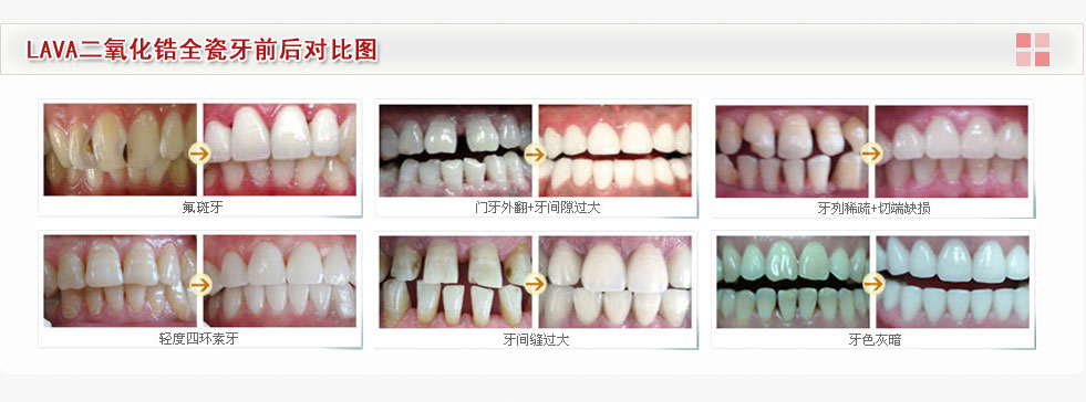LAVA二氧化锆全瓷牙牙齿修复案例前后对比图